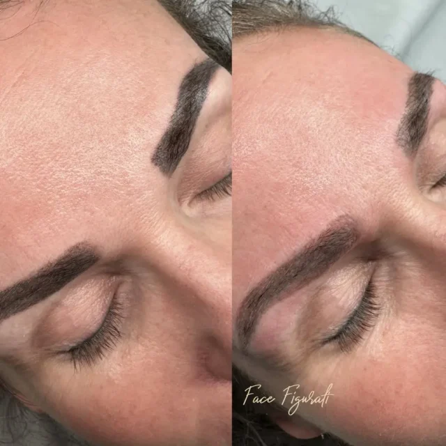 cosmetic tattoo removal
