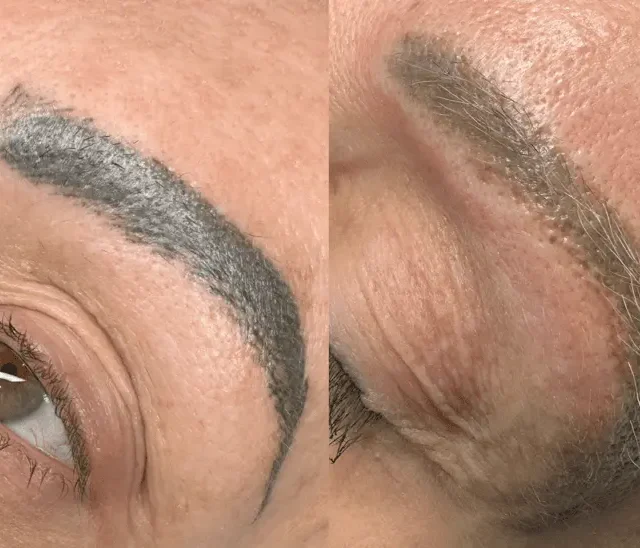 eyebrow laser removal