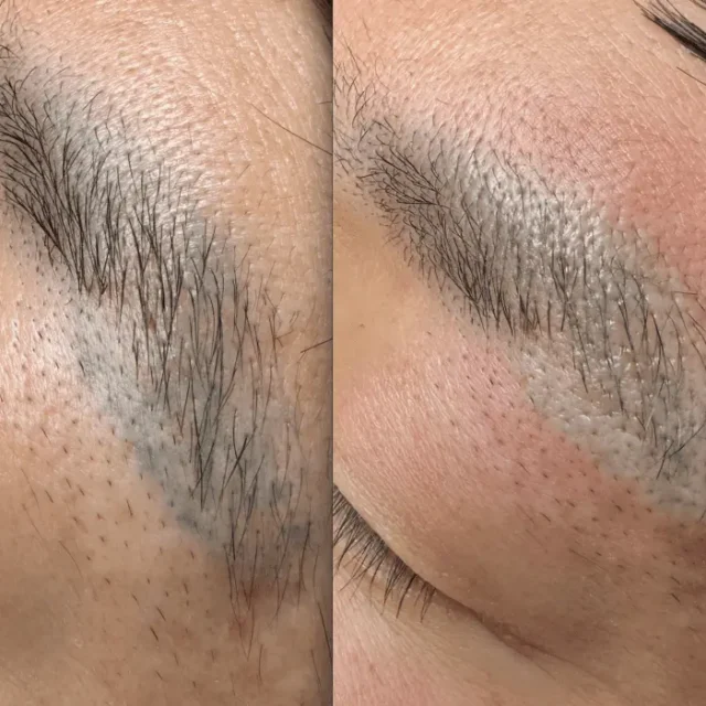 eyebrow laser tattoo removal