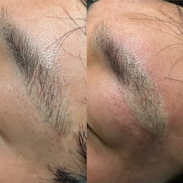 tattoo eyebrow removal