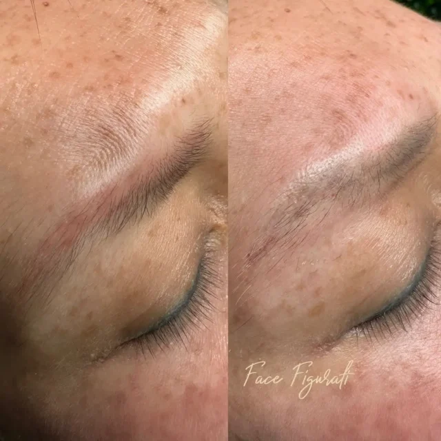 eyebrow tattoo laser removal melbourne