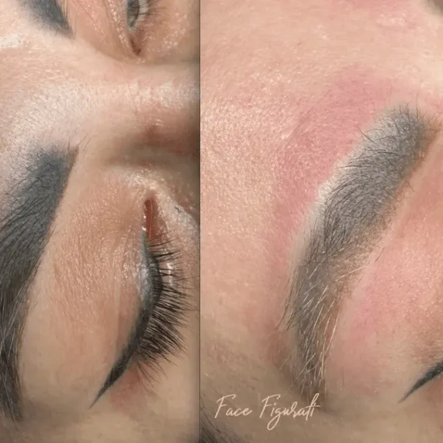 eyebrow tattoo removal