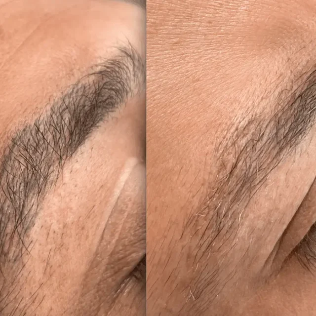 eyebrow tattoo removal before and after