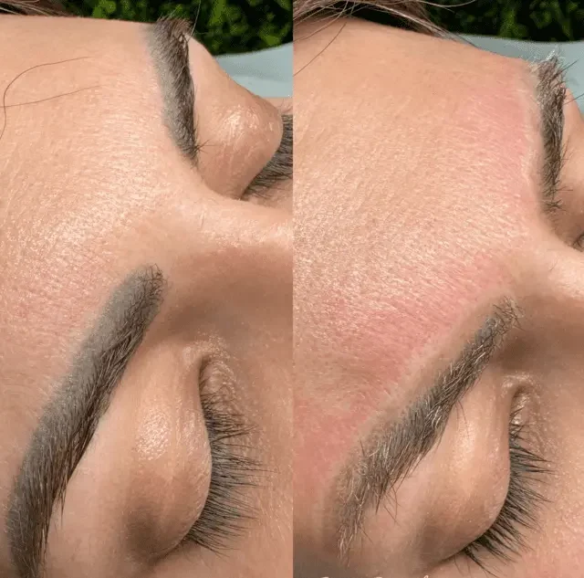 eyebrow tattoo removal melbourne