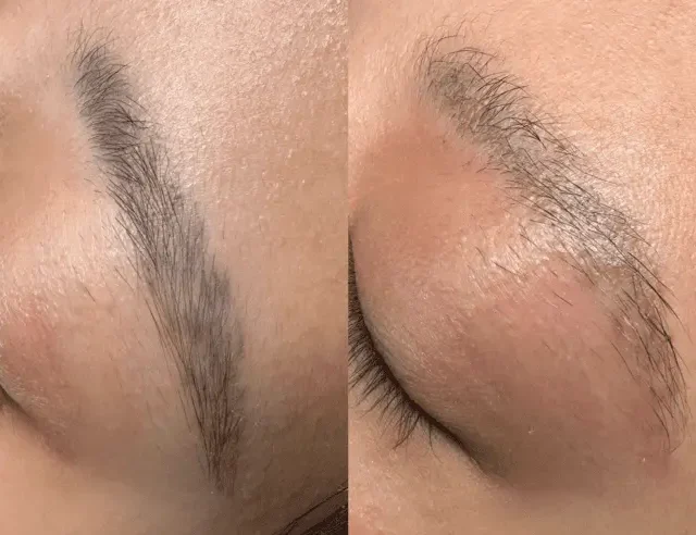 eyebrow tattoo removal near me