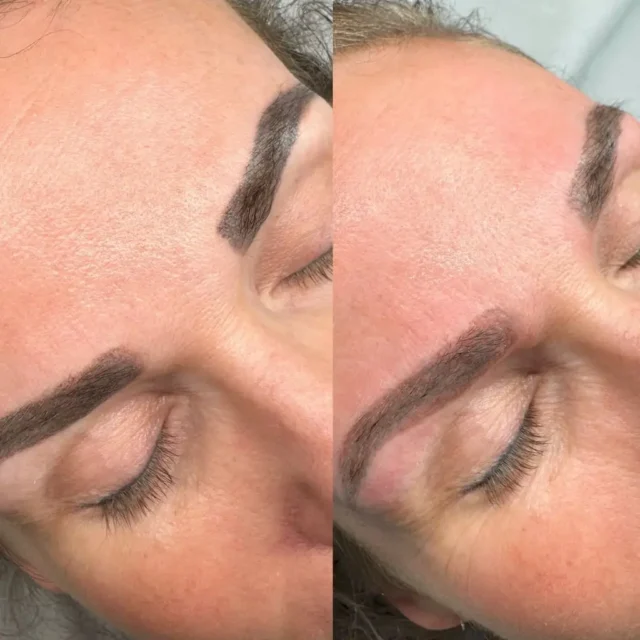 eyeliner tattoo removal near me
