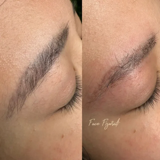 laser eyebrow tattoo removal