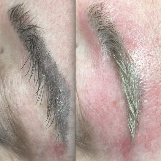 laser removal eyebrows