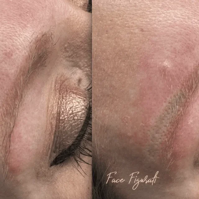 remove eyebrow tattoo