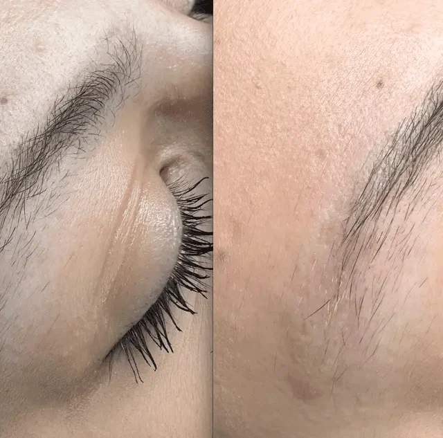 removing eyebrow tattoo