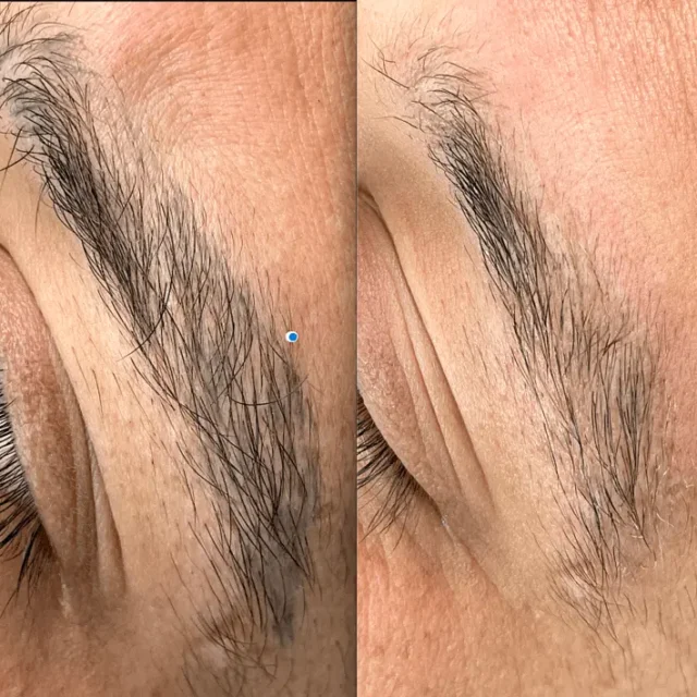 tattoo removal eyebrows