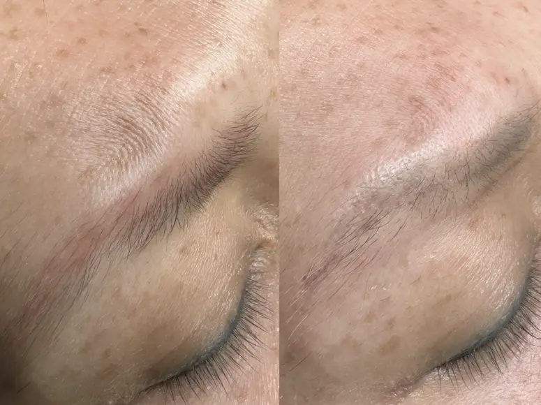eyebrow tattoo removal saline