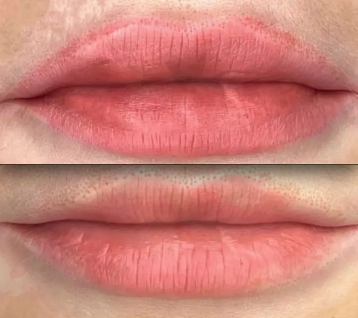 saline brow tattoo removal