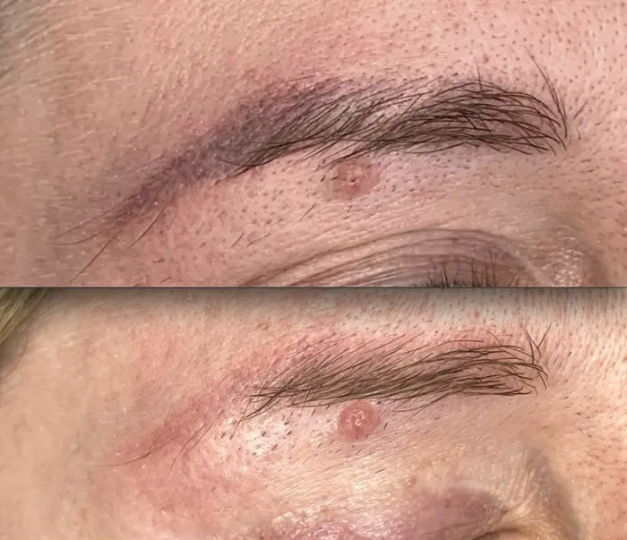 saline eyebrow tattoo removal
