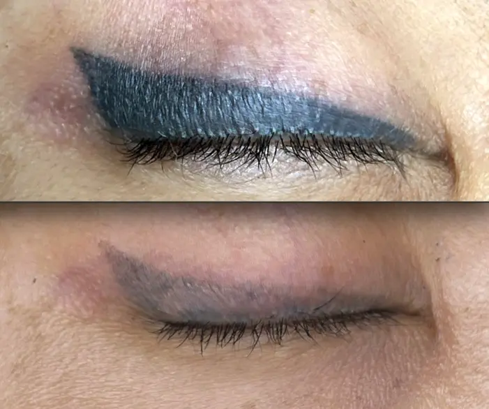 saline tattoo removal aftercare