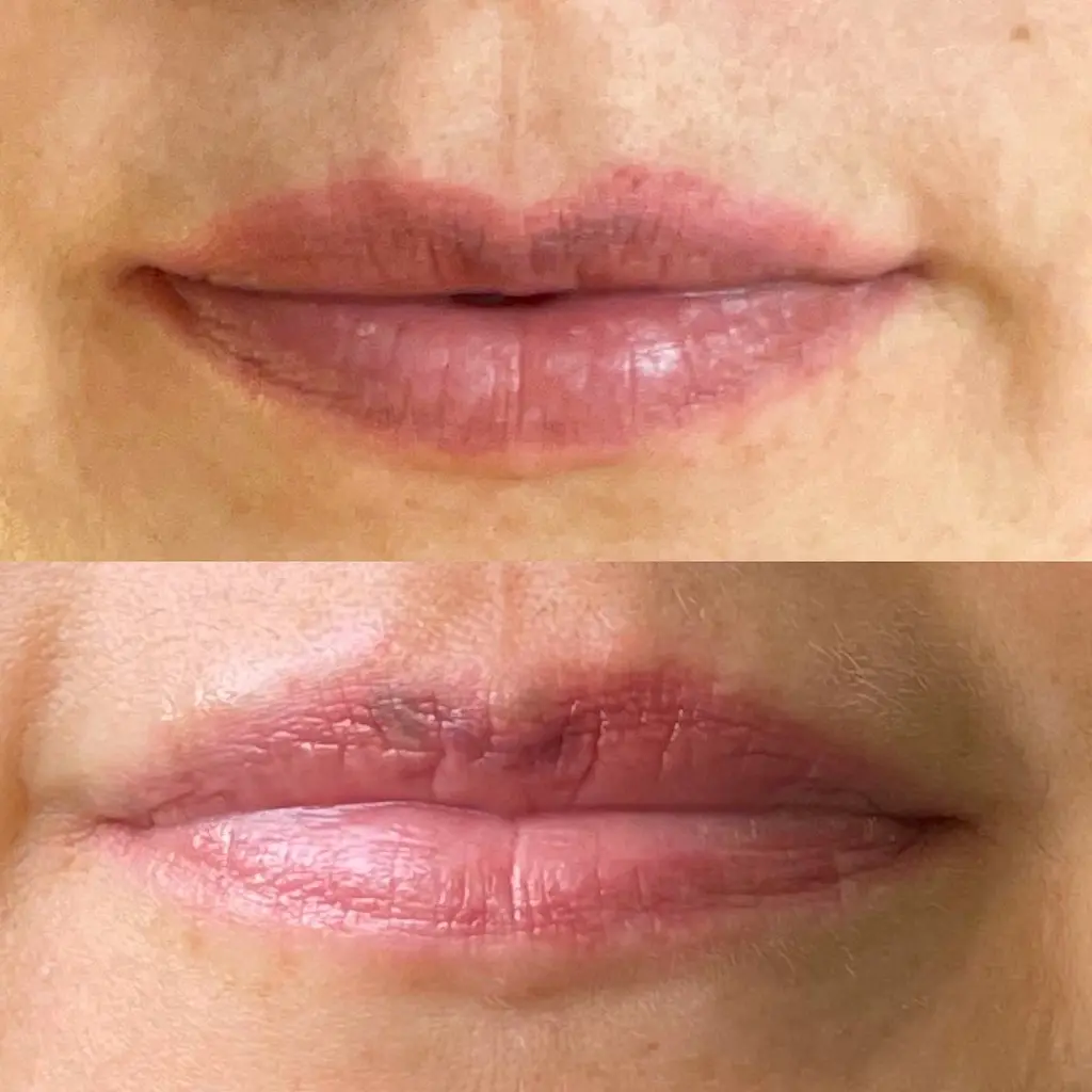 saline tattoo removal melbourne
