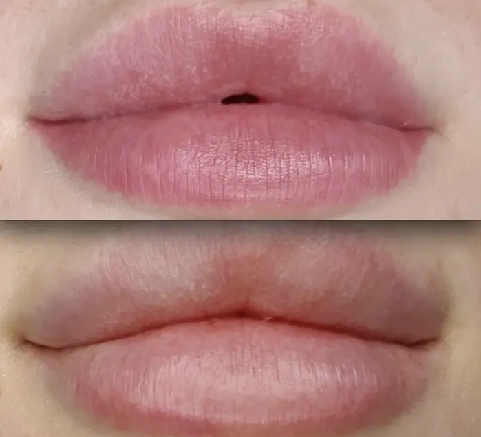 salt and saline tattoo removal before and after