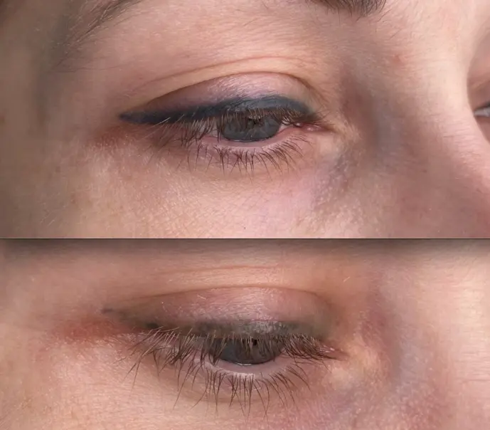 tattoo removal solution