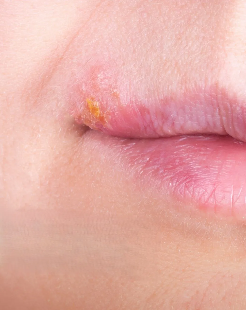 Can Cosmetic Procedures Trigger Cold Sores