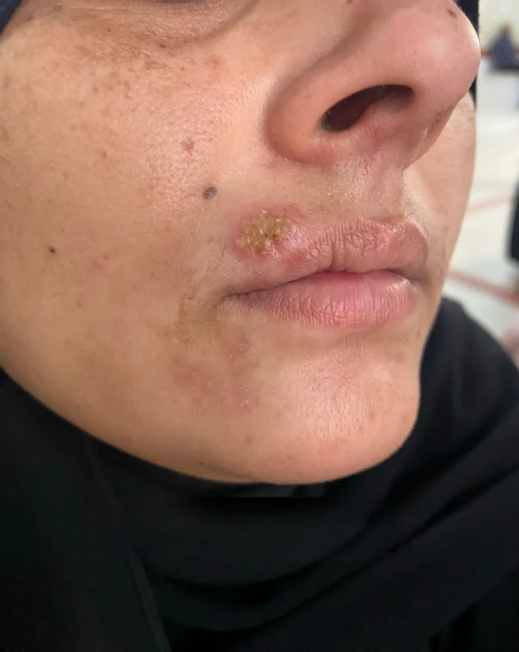 Cold Sore Virus, Key Facts