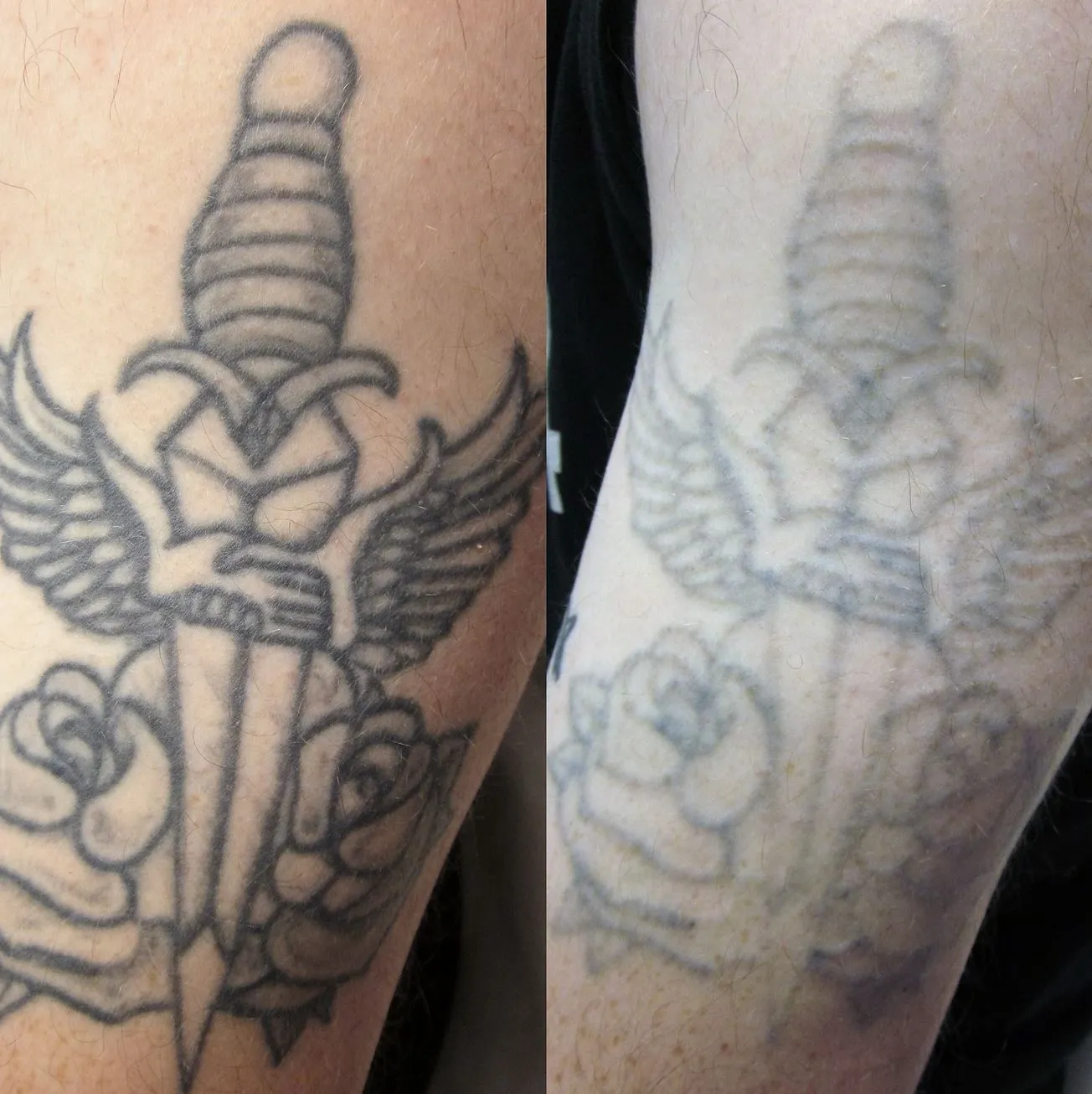 The Reality Of Laser Tattoo Removal