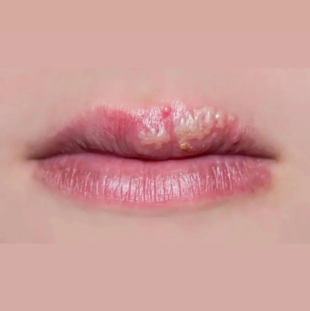 What Things Trigger the Herpes irus