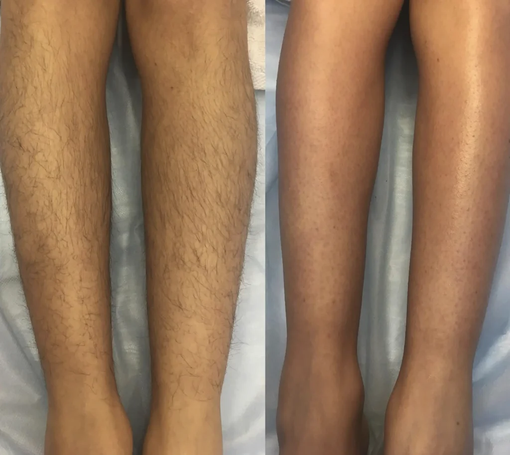 how to prep for laser hair removal