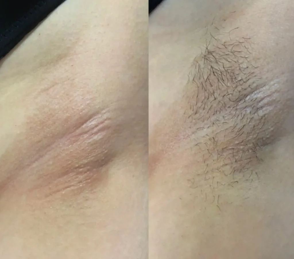 laser hair removal full body cost