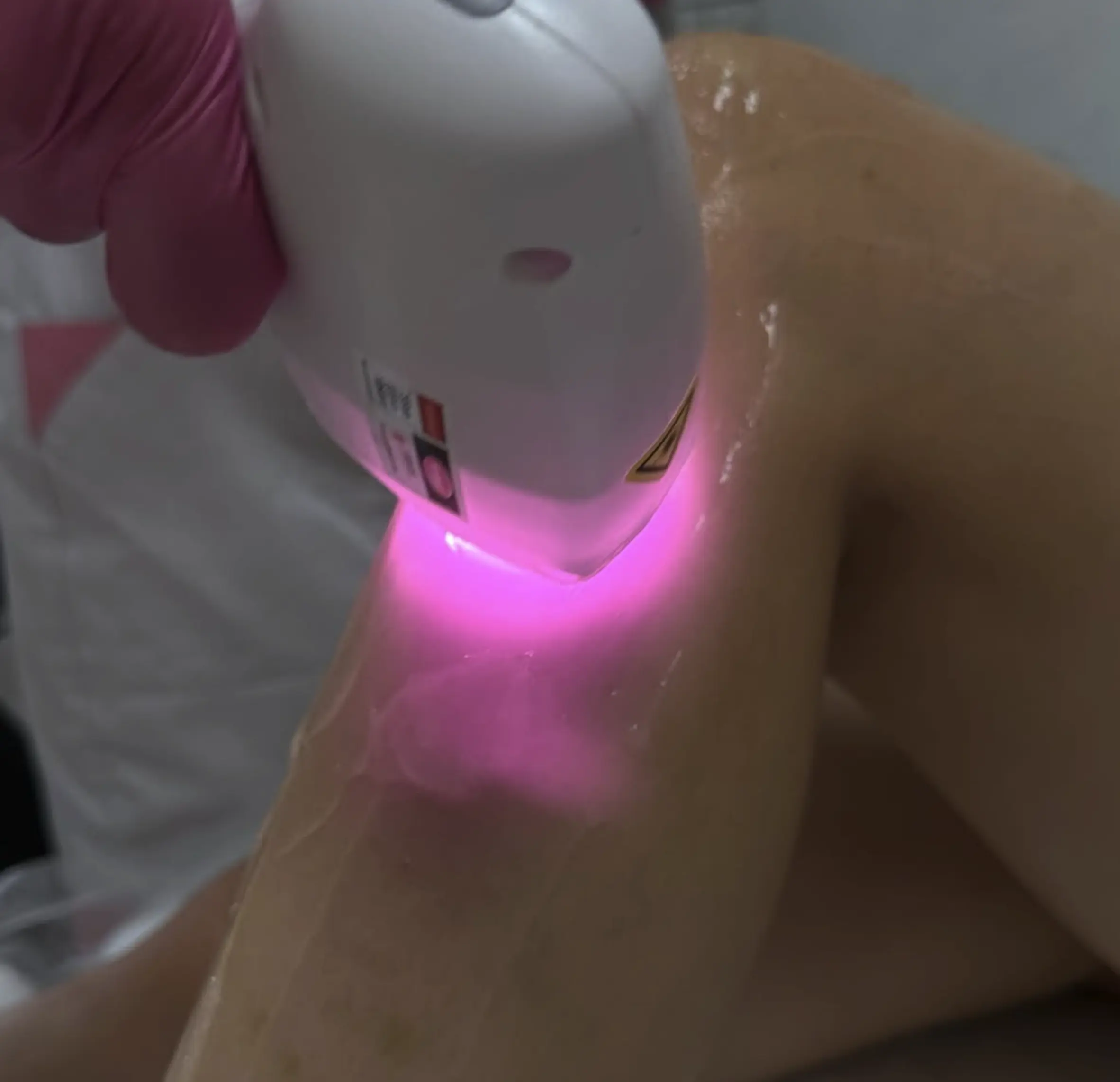 preparation for laser hair removal