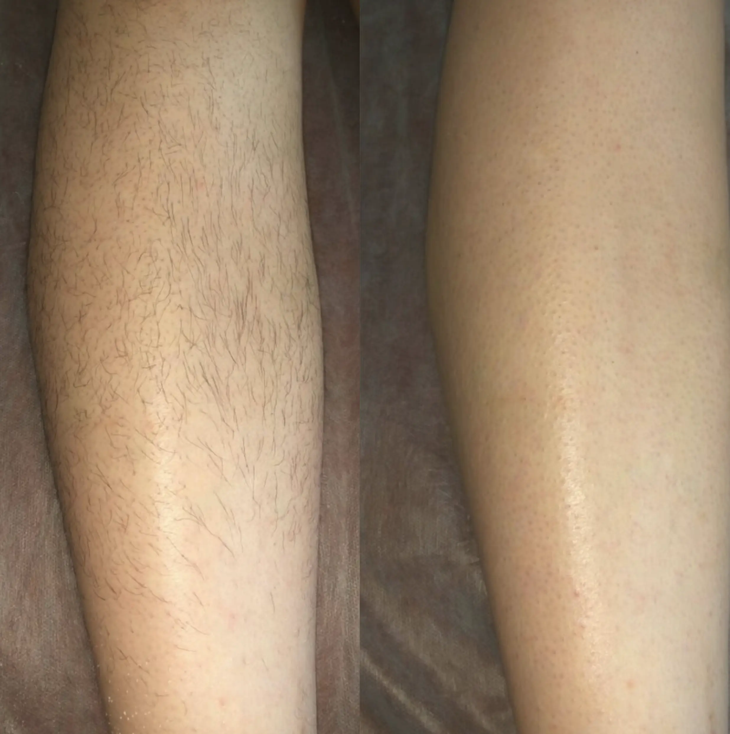 prepare for laser hair removal