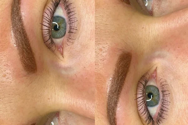 What Is The Best Eyebrow Procedure For No Eyebrows