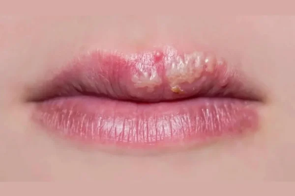 What Things Trigger the Herpes irus