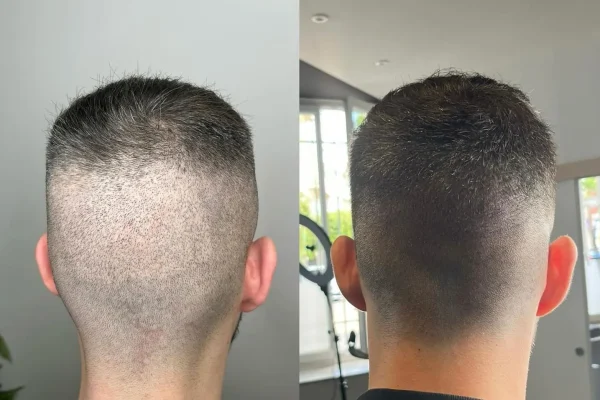 What is the History of Micropigmentation