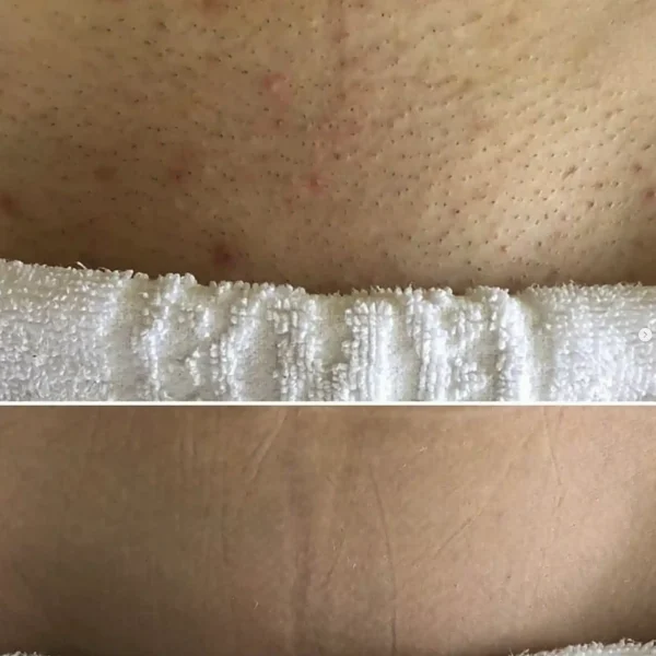 bikini hair removal