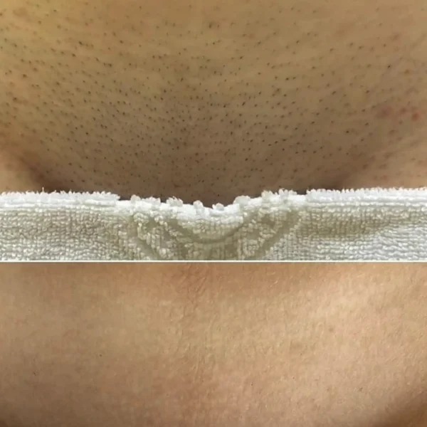 bikini laser hair removal
