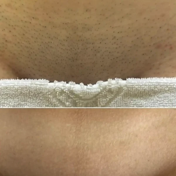 bikini laser hair removal