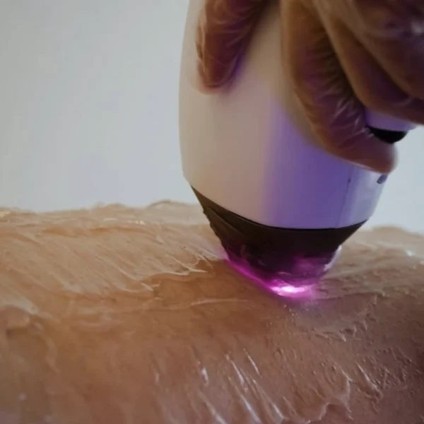bikini laser removal