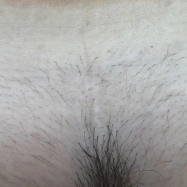 bikini line hair removal