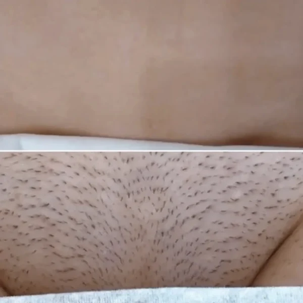 bikini line laser hair removal area