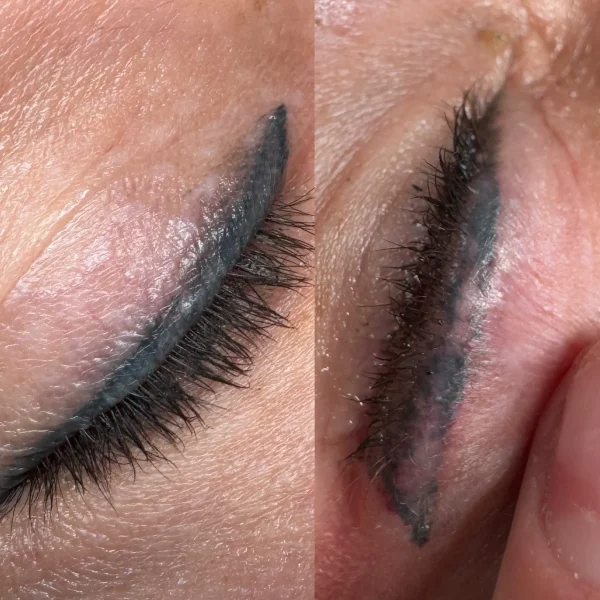 cosmetic laser tattoo removal