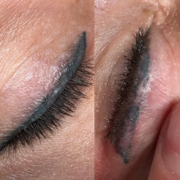 cosmetic laser tattoo removal