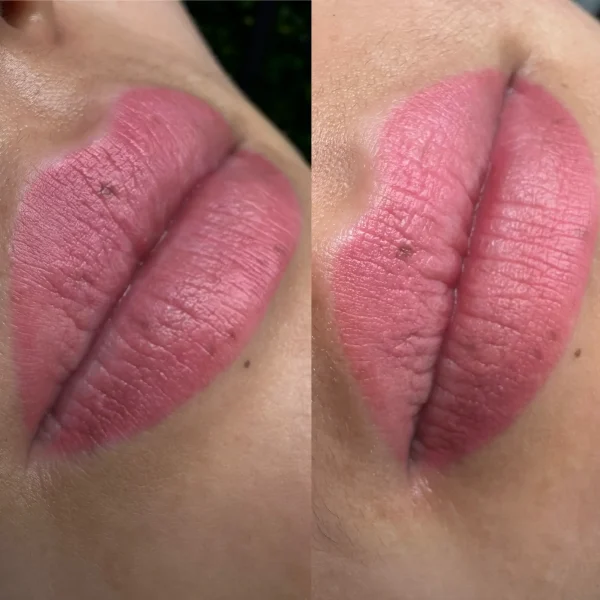 cosmetic tattoo laser removal