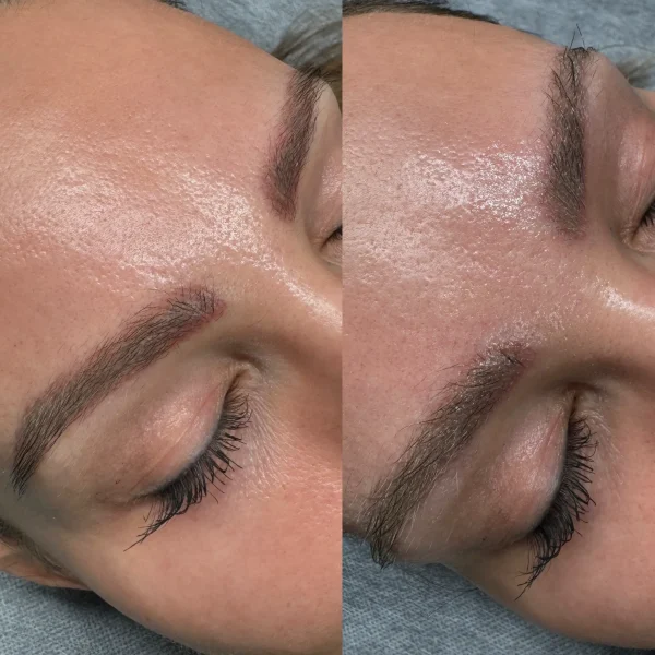 cosmetic tattoo removal box hill