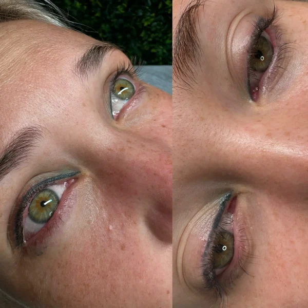cosmetic tattoo removal burwood