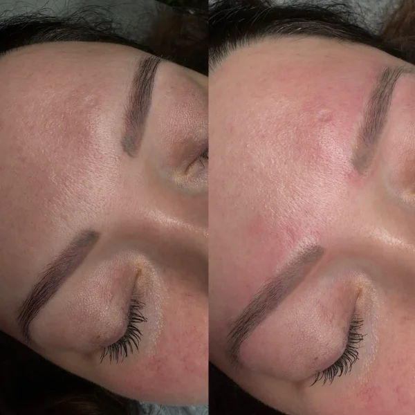 cosmetic tattoo removal footscray