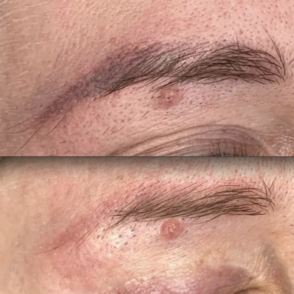 cosmetic tattoo removal heidelberg