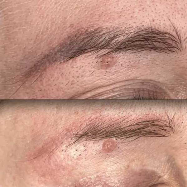 cosmetic tattoo removal heidelberg