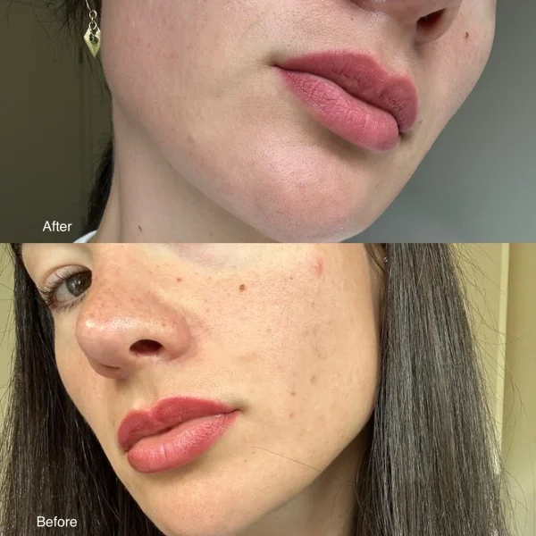 cosmetic tattoo removal melbourne cbd
