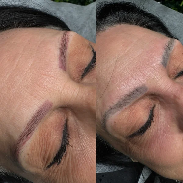 cosmetic tattoo removal melbourne