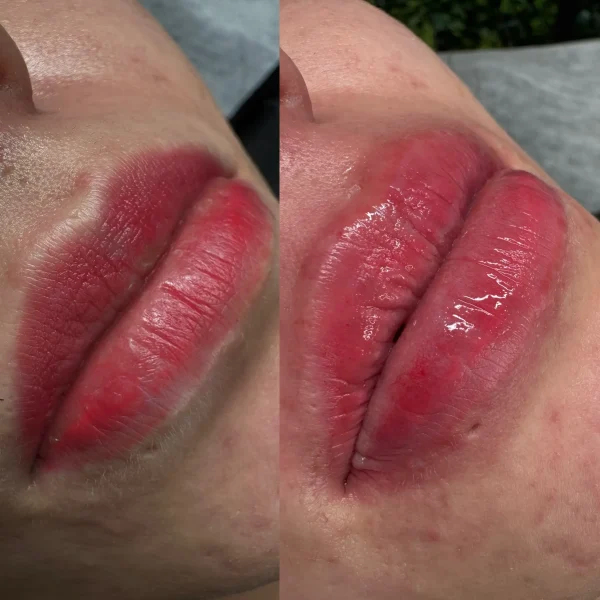 cosmetic tattoo removal moonee ponds